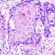 Histopatología carcinoma cáncer oral